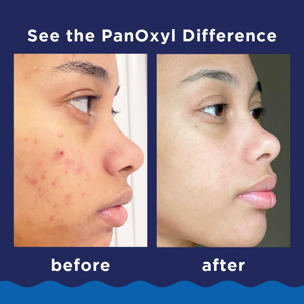 PanOxyl® Acne Foaming Wash Benzoyl Peroxide 10% Maximum Strength 5.5 oz (156 g)