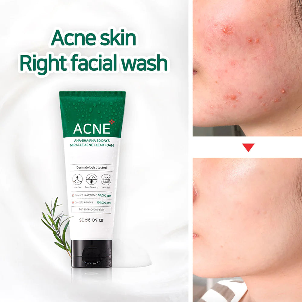 AHA, BHA, PHA 30 Days Miracle Acne Clear Foam