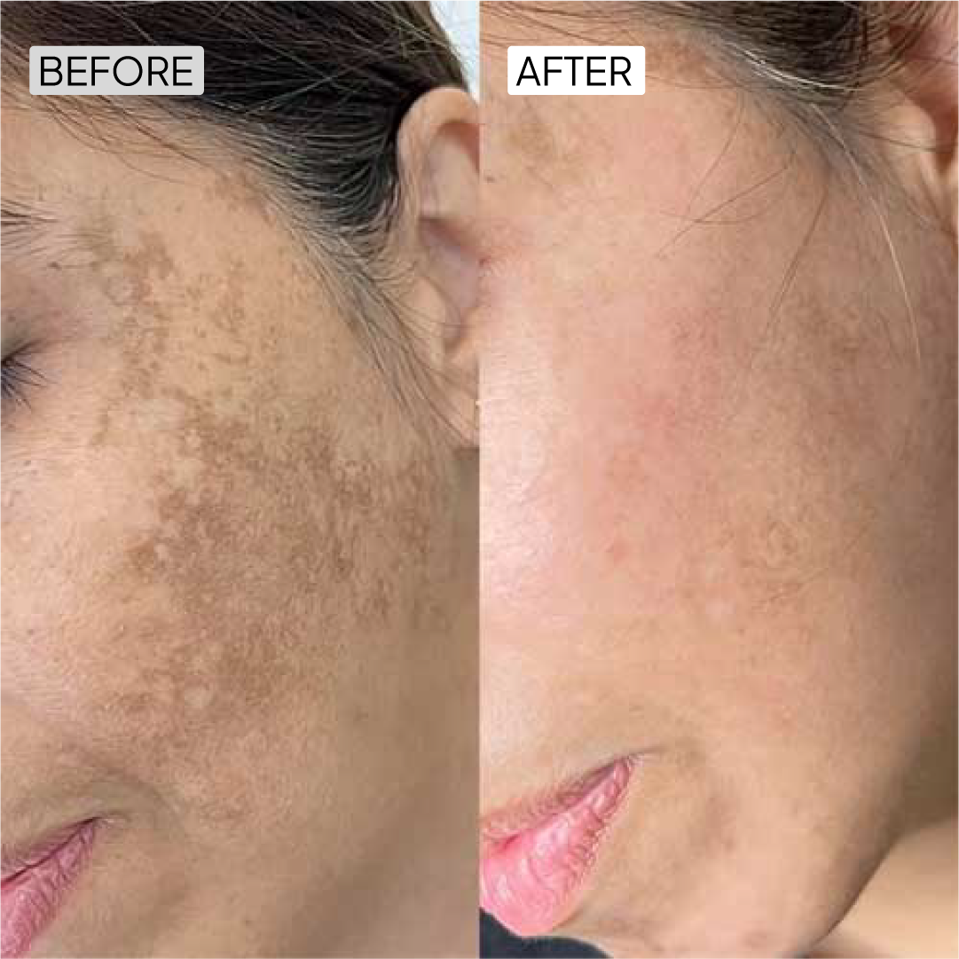 Kojic Acid Skin Lightening Cream